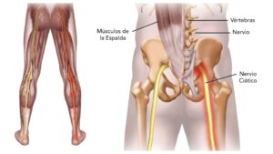 musculatura-espalda-y-ciatica